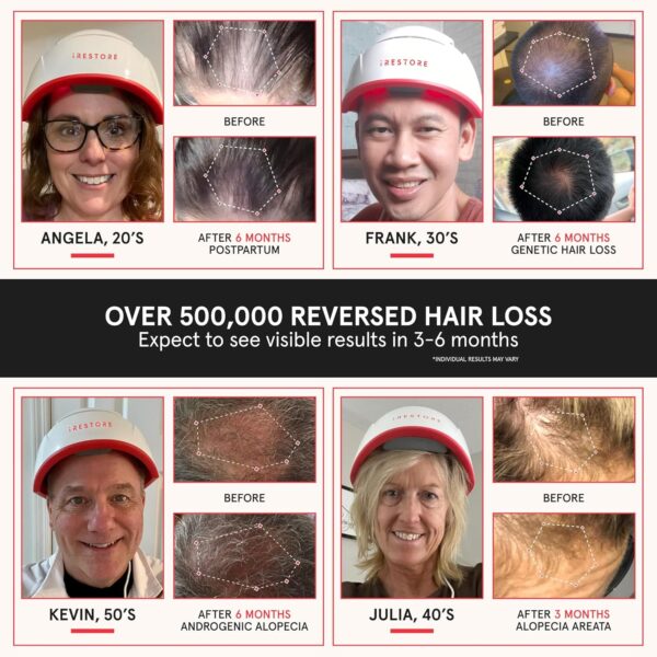 iRestore Essential Laser Hair Loss Treatment - Image 11