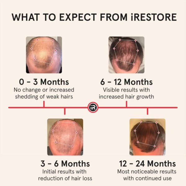 iRestore Essential Laser Hair Loss Treatment - Image 9