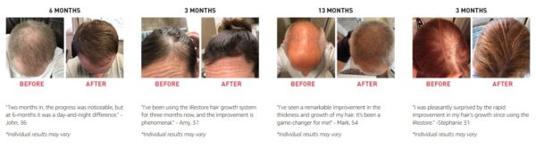 iRestore Essential Laser Hair Loss Treatment - Image 12