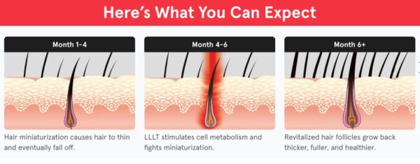 iRestore Essential Laser Hair Loss Treatment - Image 8