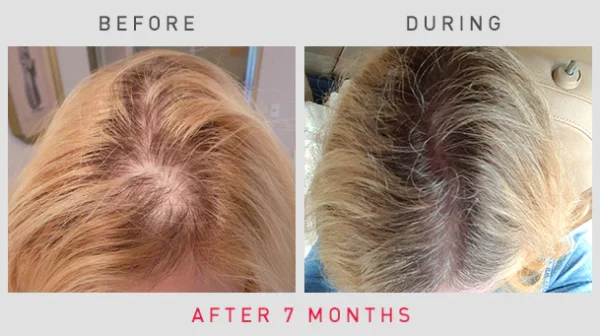 iRestore Essential Laser Hair Loss Treatment - Image 5